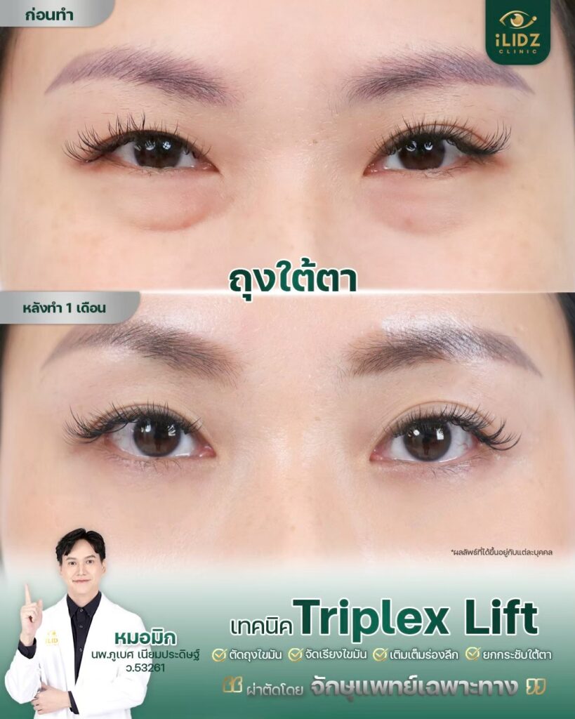 ผลผ่าตัดถุงใต้ตา Lower Blepharoplasty หลังทำ โดยหมอมิก iLIDZ Clinic