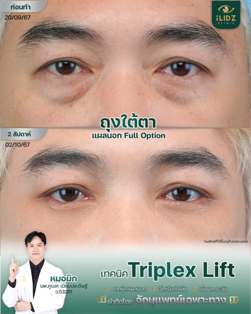 ถุงใต้ตา ก่อนผ่าตัด Lower Blepharoplasty หมอมิก iLIDZ Clinic
