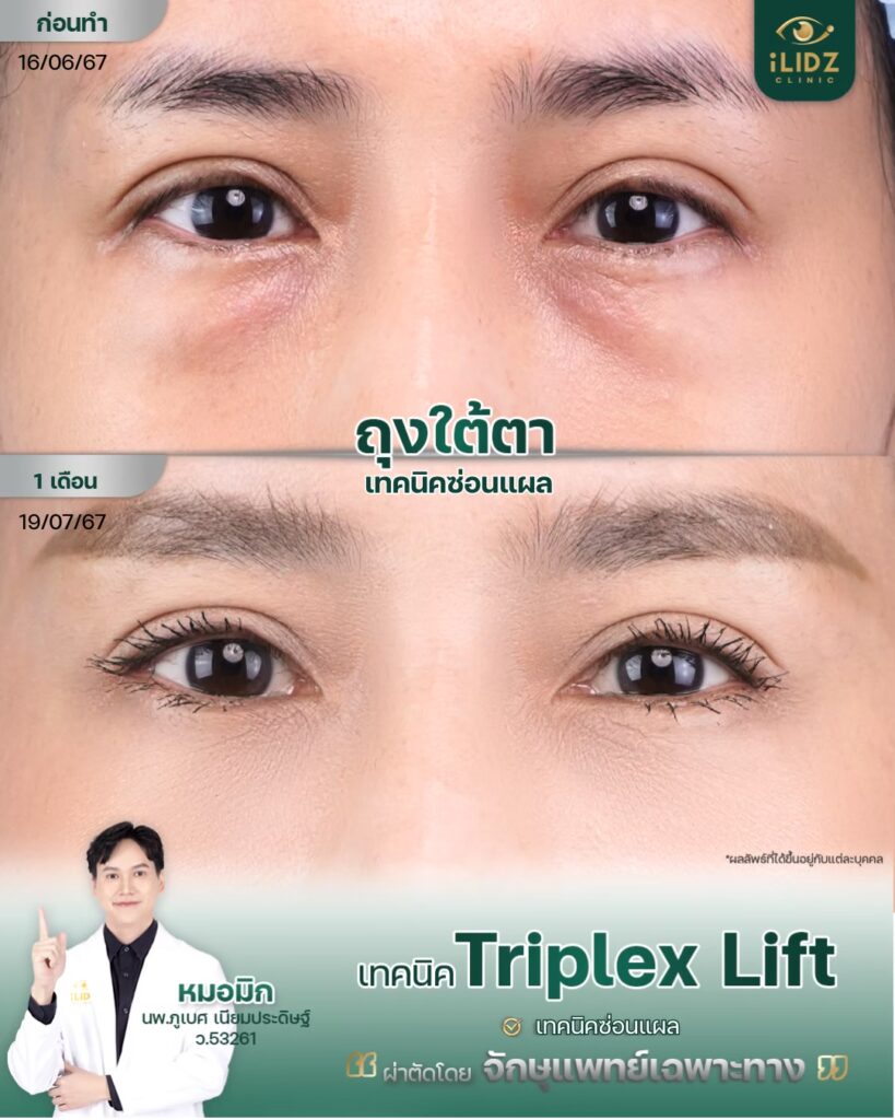 ผลผ่าตัดถุงใต้ตา Lower Blepharoplasty หลังทำ โดยหมอมิก iLIDZ Clinic