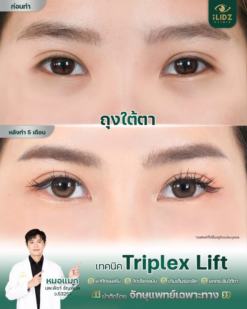 ถุงใต้ตา ก่อนผ่าตัด Lower Blepharoplasty หมอแมก iLIDZ Clinic