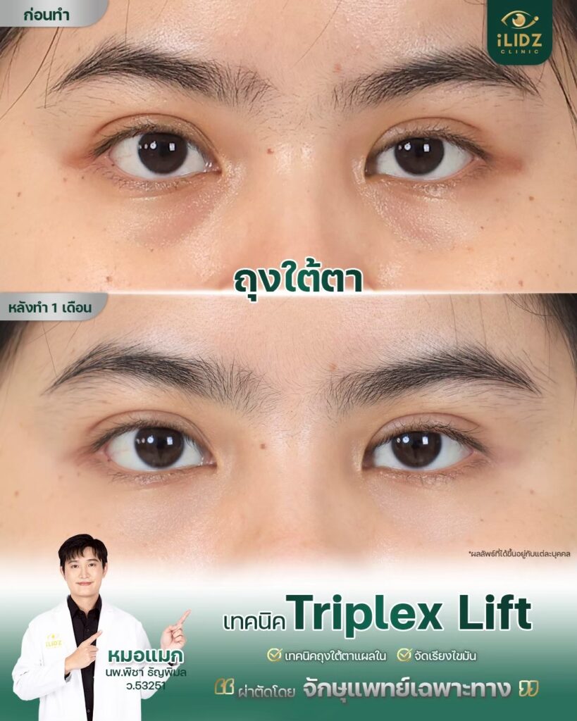 ถุงใต้ตา ก่อนผ่าตัด Lower Blepharoplasty หมอแมก iLIDZ Clinic