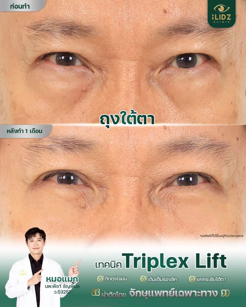 ผลผ่าตัดถุงใต้ตา Lower Blepharoplasty หลังทำ โดยหมอแมก iLIDZ Clinic