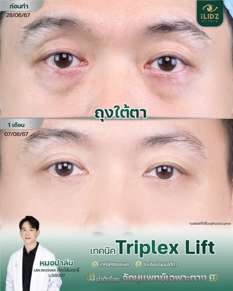 ถุงใต้ตา ก่อนผ่าตัด Lower Blepharoplasty หมอปาล์ม iLIDZ Clinic