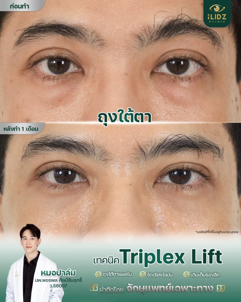 ผลผ่าตัดถุงใต้ตา Lower Blepharoplasty หลังทำ โดยหมอปาล์ม iLIDZ Clinic