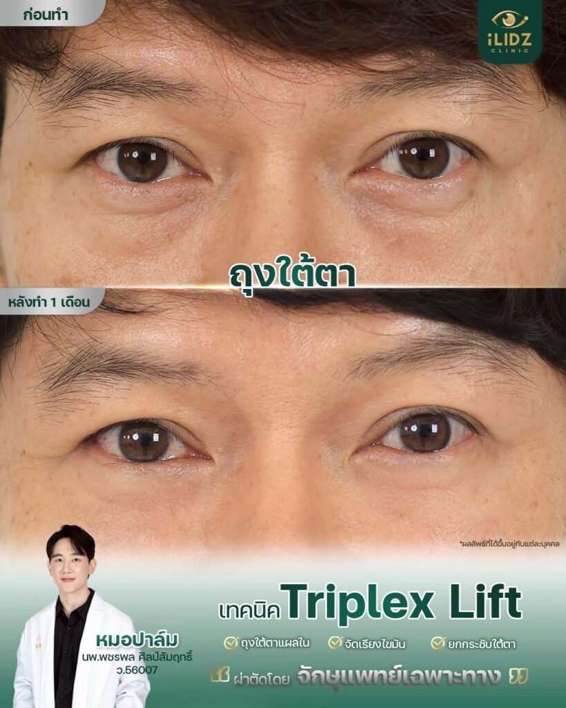 ผลผ่าตัดถุงใต้ตา Lower Blepharoplasty หลังทำ โดยหมอปาล์ม iLIDZ Clinic