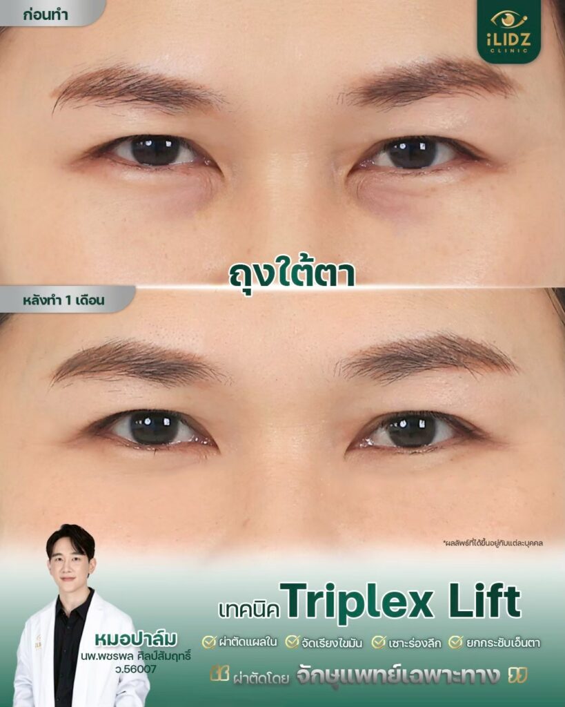 ถุงใต้ตา ก่อนผ่าตัด Lower Blepharoplasty หมอปาล์ม iLIDZ Clinic