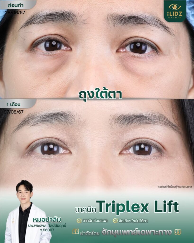 ผลผ่าตัดถุงใต้ตา Lower Blepharoplasty หลังทำ โดยหมอปาล์ม iLIDZ Clinic