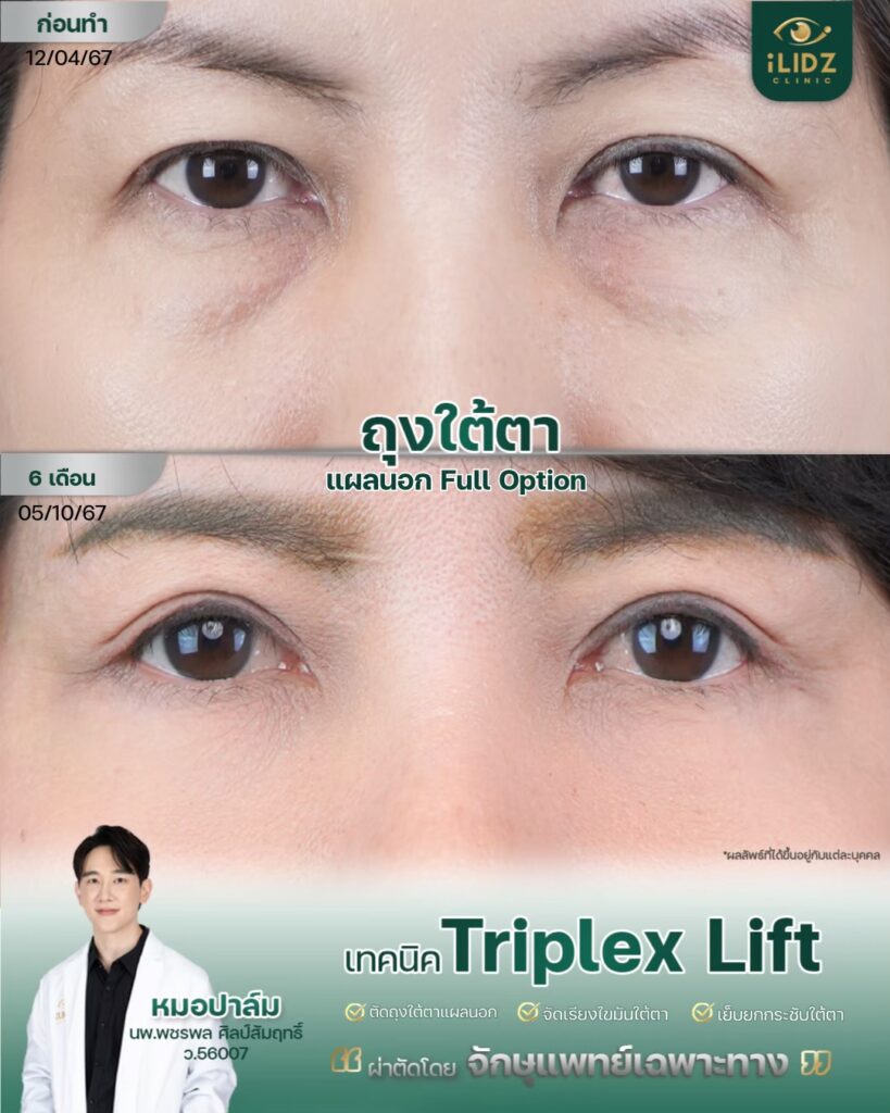 ถุงใต้ตา ก่อนผ่าตัด Lower Blepharoplasty หมอปาล์ม iLIDZ Clinic