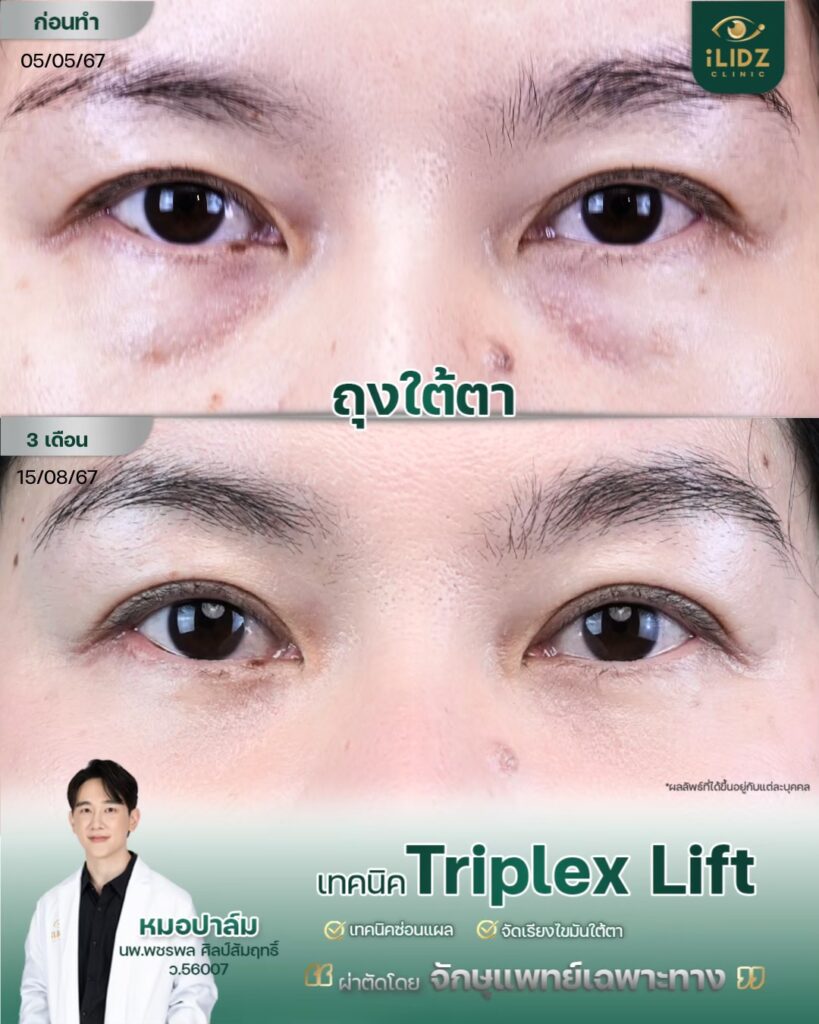 ผลผ่าตัดถุงใต้ตา Lower Blepharoplasty หลังทำ โดยหมอปาล์ม iLIDZ Clinic