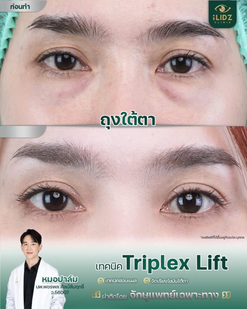 ถุงใต้ตา ก่อนผ่าตัด Lower Blepharoplasty หมอปาล์ม iLIDZ Clinic