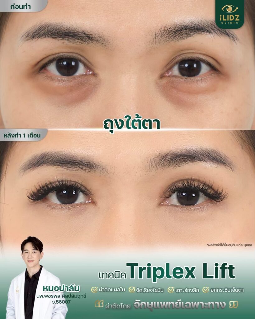ผลผ่าตัดถุงใต้ตา Lower Blepharoplasty หลังทำ โดยหมอปาล์ม iLIDZ Clinic
