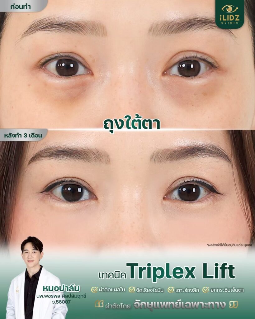 ถุงใต้ตา ก่อนผ่าตัด Lower Blepharoplasty หมอปาล์ม iLIDZ Clinic