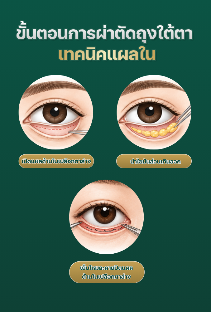 ผ่าตัดถุงใต้ตาแผลใน