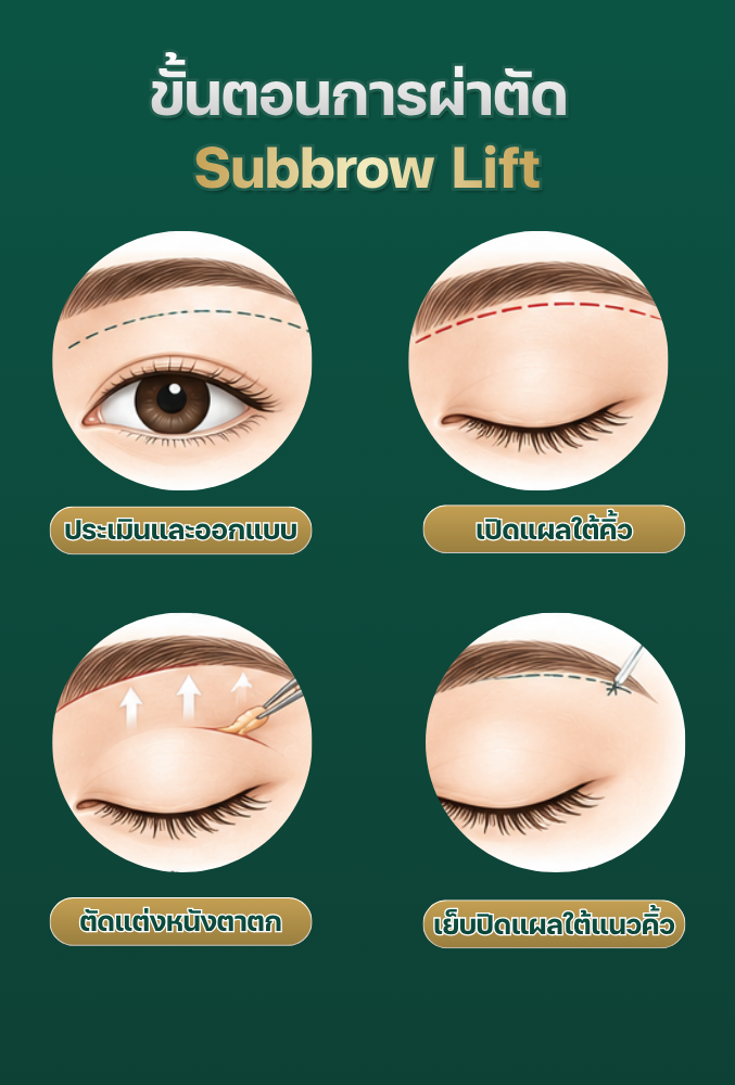 Subbrow lift