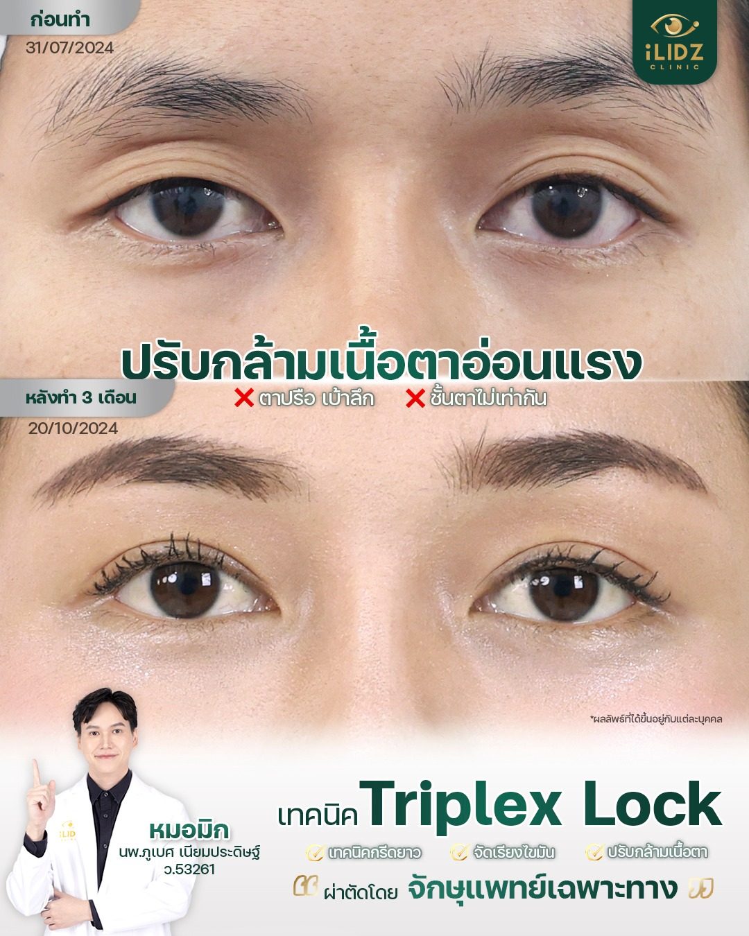 รีวิวรักษา Ptosis กล้ามเนื้อตาอ่อนแรง ก่อน-หลัง iLIDZ Clinic