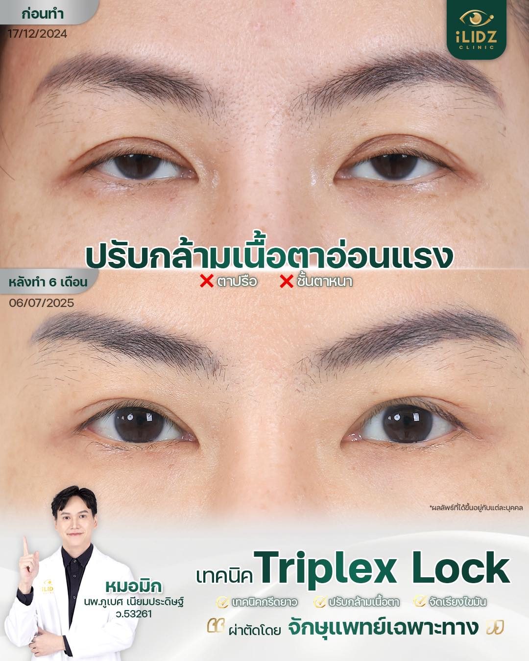 ผ่าตัดกล้ามเนื้อตาอ่อนแรง (Ptosis Correction) ก่อน-หลัง iLIDZ Clinic
