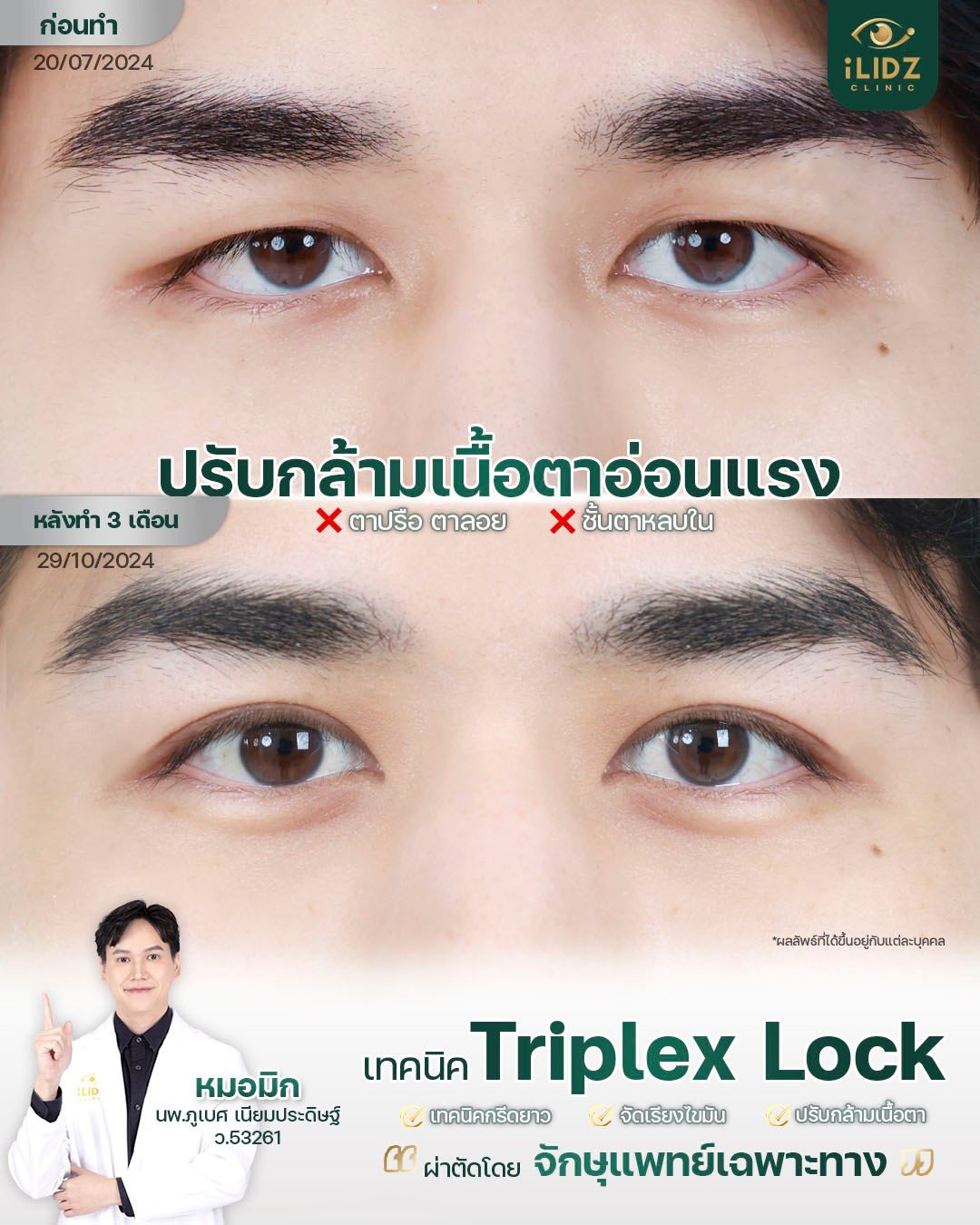เคสปรับกล้ามเนื้อตาอ่อนแรง (Ptosis) ก่อน-หลัง iLIDZ Clinic