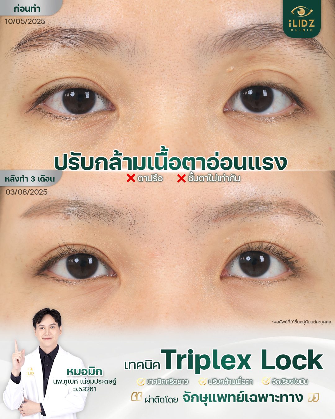 รีวิวแก้กล้ามเนื้อตาอ่อนแรง Ptosis ก่อน-หลัง iLIDZ Clinic จักษุแพทย์