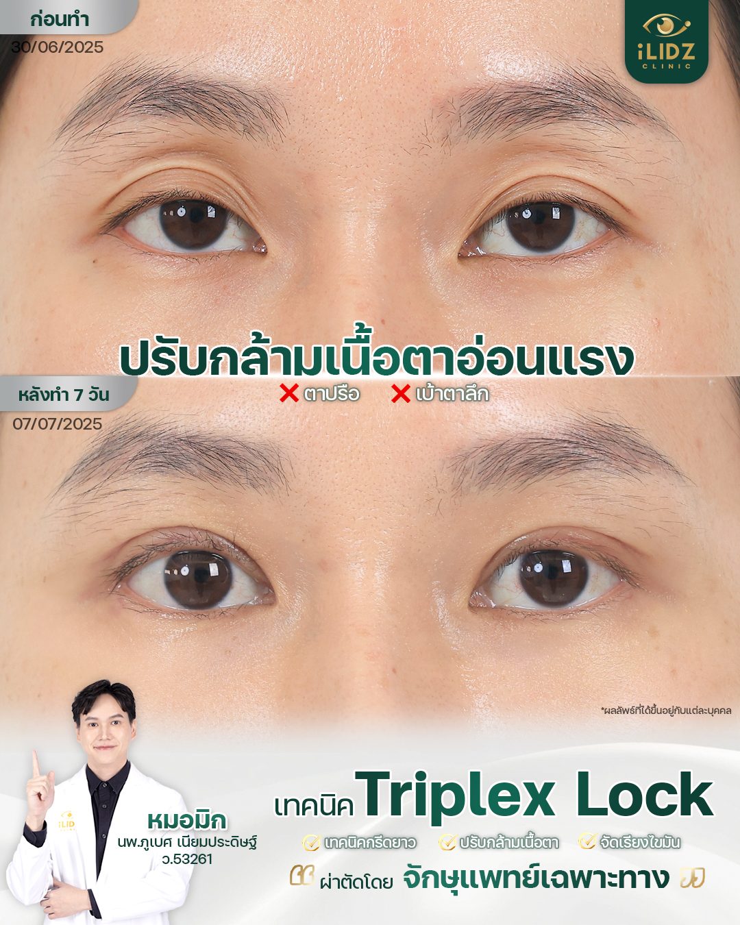 กล้ามเนื้อตาอ่อนแรง (Ptosis) ก่อน-หลังรักษา iLIDZ Clinic จักษุแพทย์