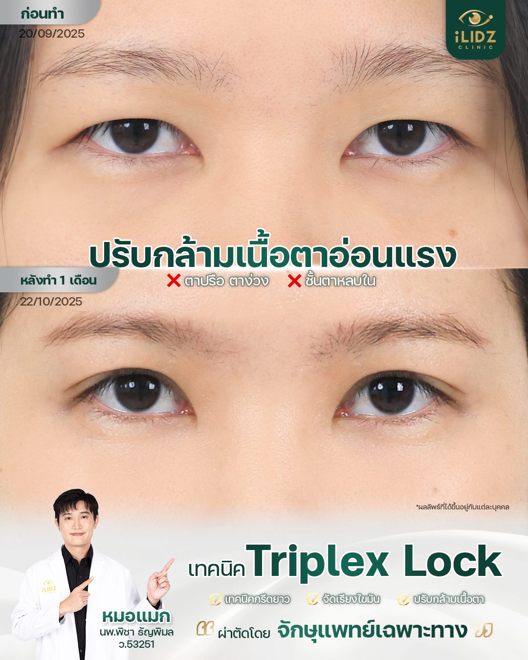 ปรับกล้ามเนื้อตาอ่อนแรง (Ptosis Correction) ผลลัพธ์ก่อน-หลัง iLIDZ Clinic