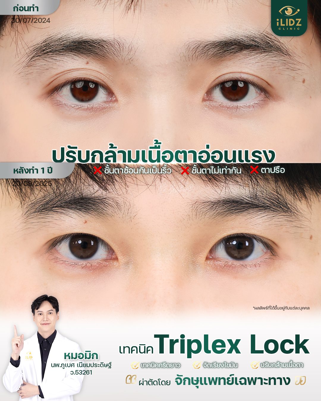 ผ่าตัดปรับกล้ามเนื้อตาอ่อนแรง (Ptosis Correction) ก่อน-หลัง iLIDZ Clinic