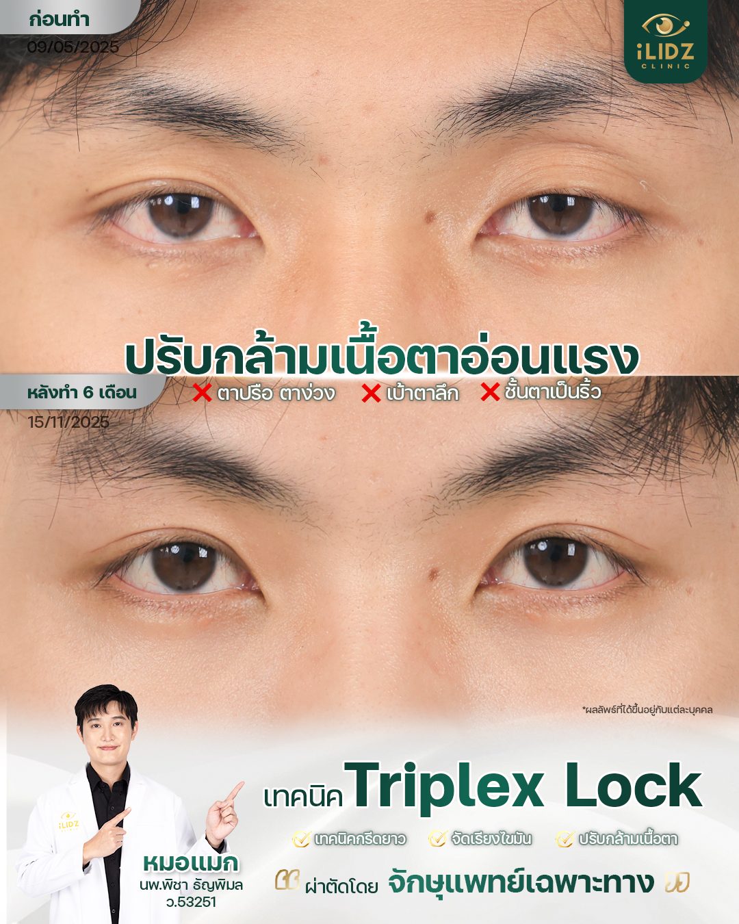 ผลการปรับกล้ามเนื้อตาอ่อนแรง (Ptosis) เทคนิค Triplex Lock ก่อน-หลัง iLIDZ Clinic