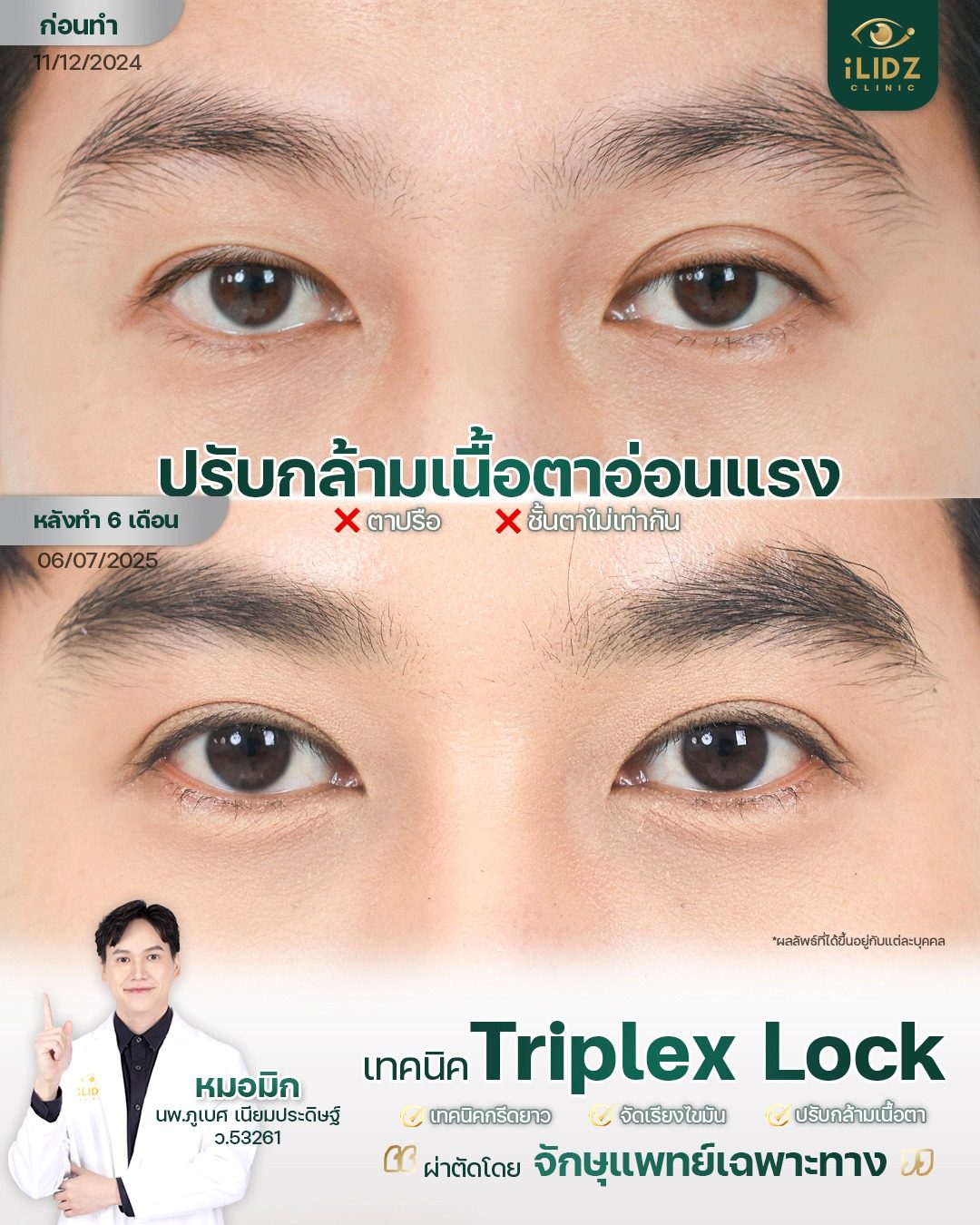 ผลรักษา Ptosis กล้ามเนื้อตาอ่อนแรง ก่อน-หลัง 6 เดือน iLIDZ Clinic