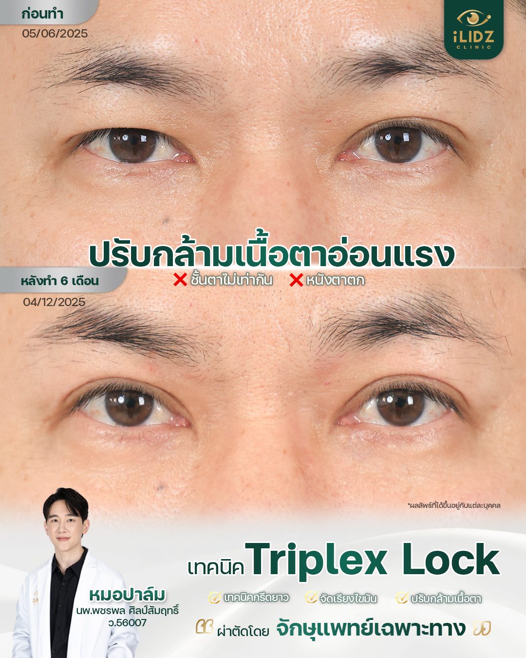 ปรับกล้ามเนื้อตาอ่อนแรง (Ptosis) เทคนิค Triplex Lock ผลลัพธ์ก่อน-หลัง iLIDZ Clinic