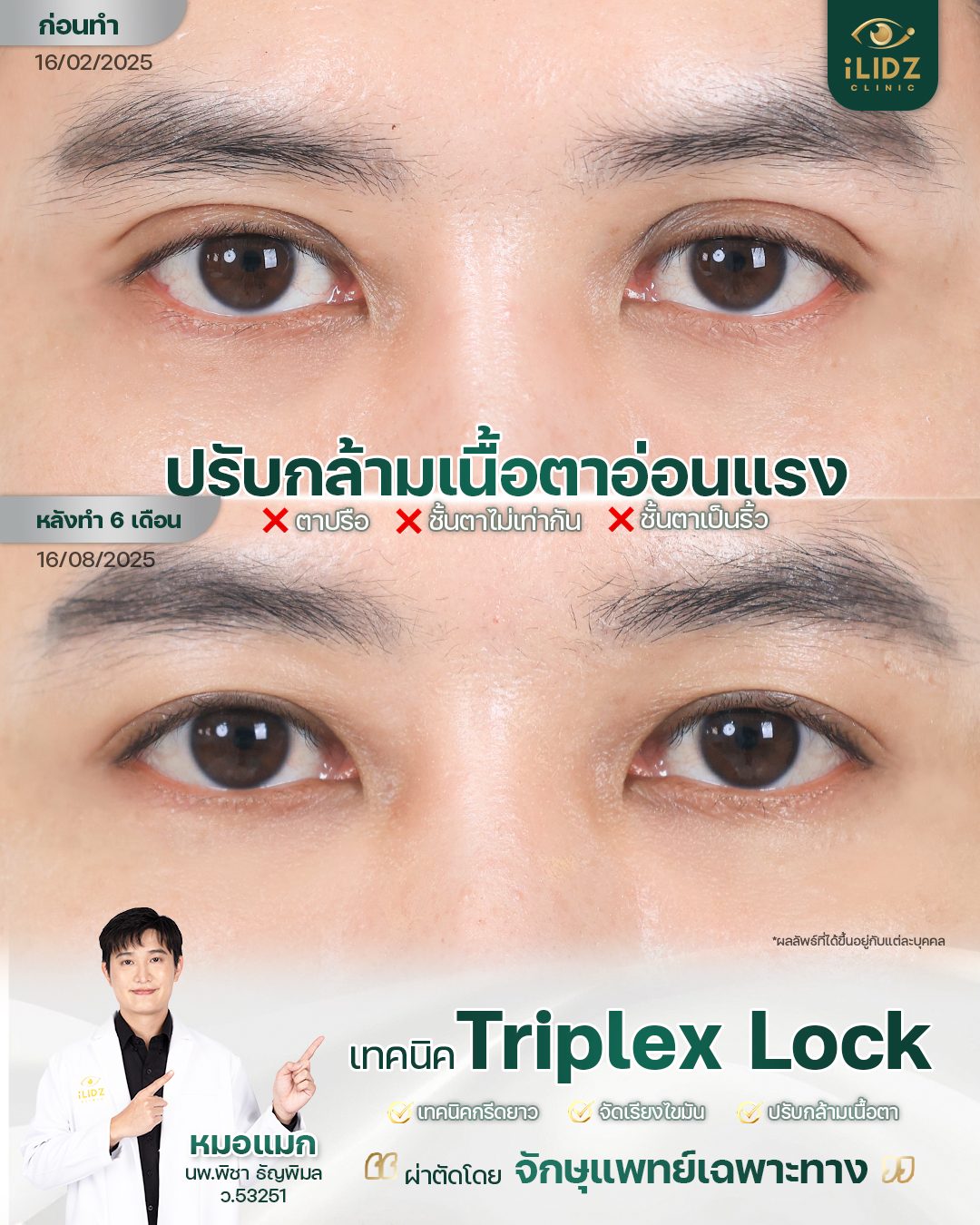 แก้ตาตก กล้ามเนื้อตาอ่อนแรง (Ptosis) ก่อน-หลัง iLIDZ Clinic