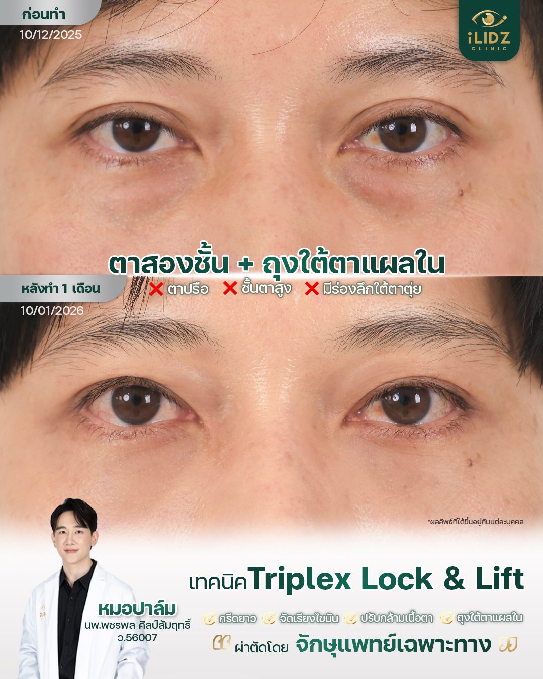 ตาสองชั้น พร้อมถุงใต้ตา