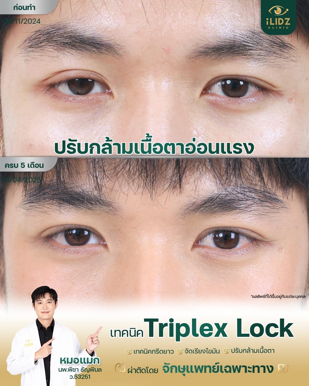 ก่อนหลังแก้กล้ามเนื้อตาอ่อนแรง คุณข้าว เทคนิค Triplex Lock iLIDZ Clinic
